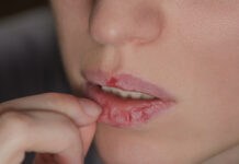 Bibir Kering dan berdarah? Ternyata ini penyebabnya