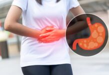 GERD: Penyakit Asam Lambung yang Tak Boleh Diremehkan gerd