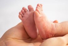 Kenali Gejala Flu Singapura yang Menyerang Anak-anak